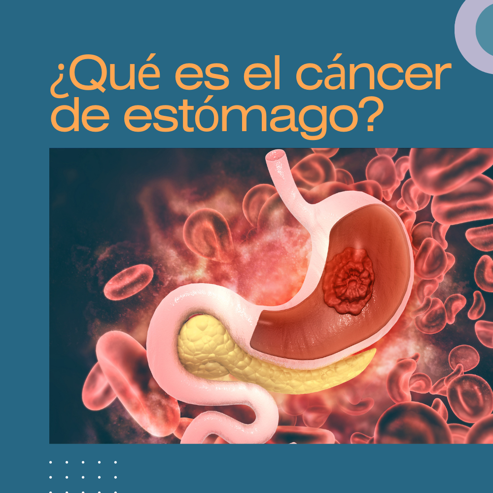 ¿Qué es el cáncer de estómago?