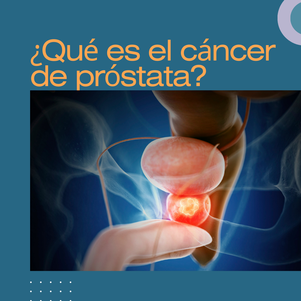 ¿Qué es el cáncer de próstata?